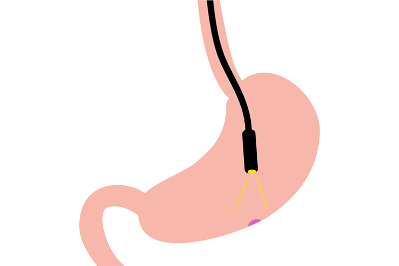 ピロリ菌の除菌治療について